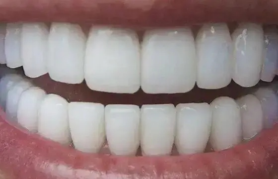 6. COMO ESCREVEMOS DENTE E DENTES EM INGLÊS?